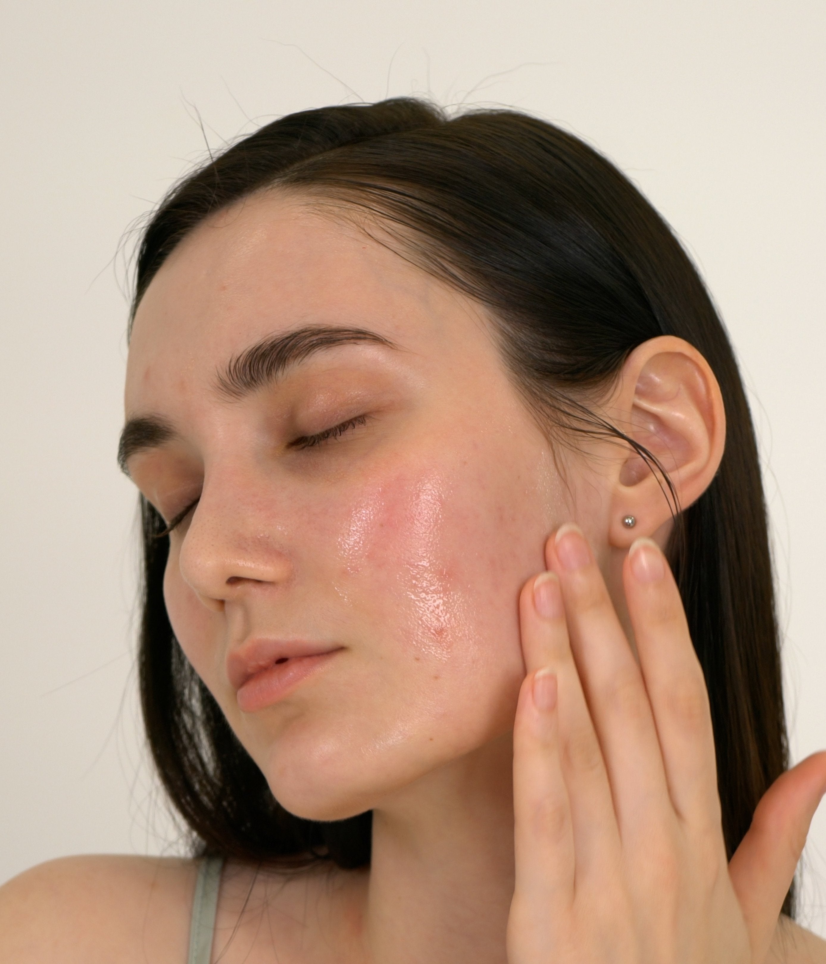 Acne prone skin
